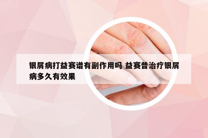 银屑病打益赛谱有副作用吗 益赛普治疗银屑病多久有效果