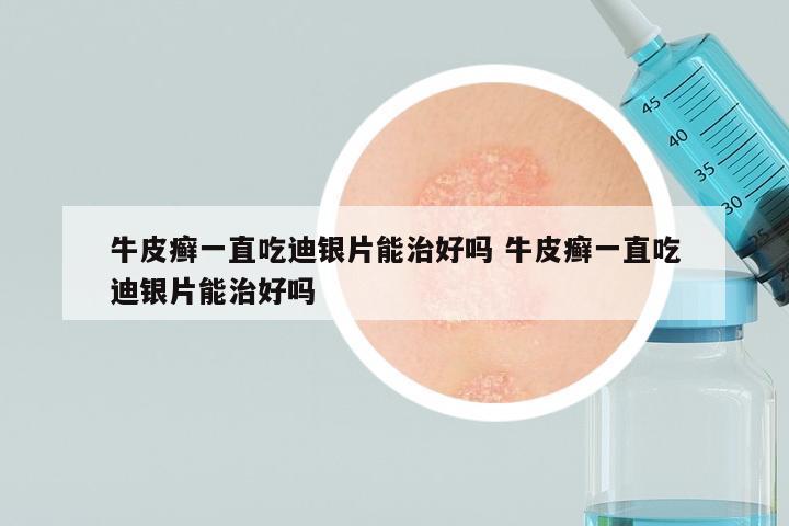 牛皮癣一直吃迪银片能治好吗 牛皮癣一直吃迪银片能治好吗