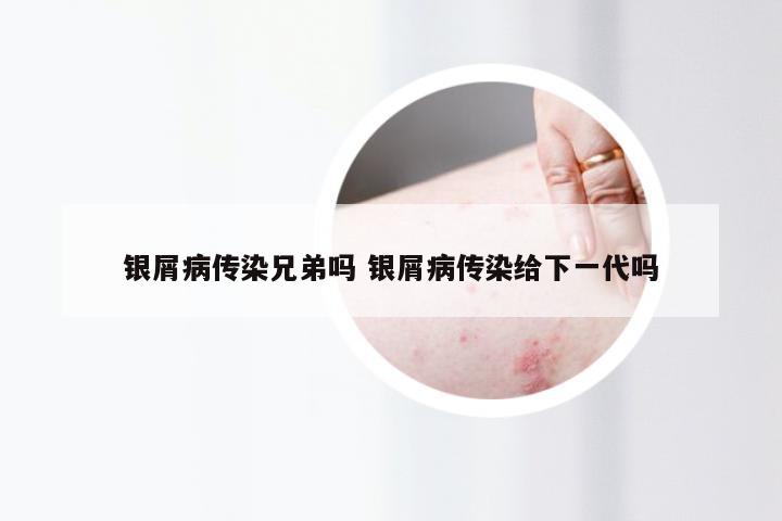银屑病传染兄弟吗 银屑病传染给下一代吗