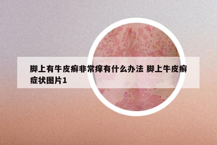 脚上有牛皮癣非常痒有什么办法 脚上牛皮癣症状图片1