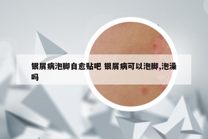 银屑病泡脚自愈贴吧 银屑病可以泡脚,泡澡吗