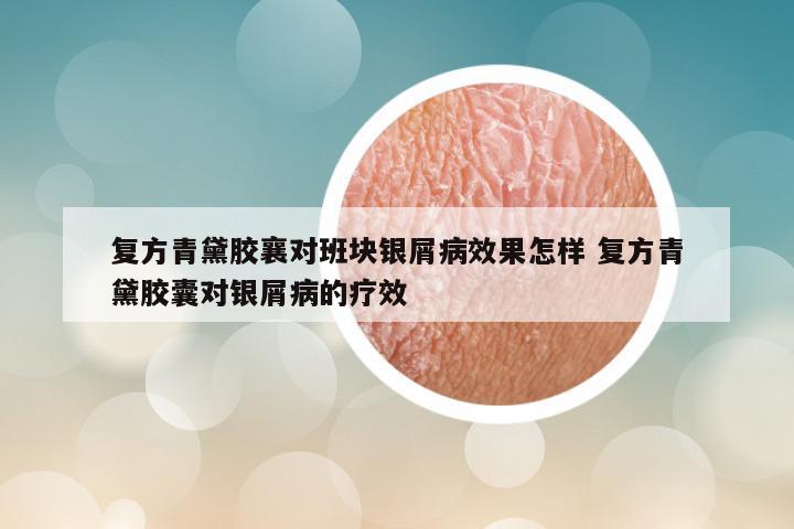 复方青黛胶襄对班块银屑病效果怎样 复方青黛胶囊对银屑病的疗效