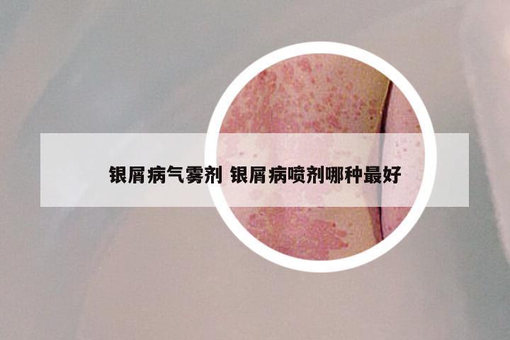 银屑病气雾剂 银屑病喷剂哪种最好
