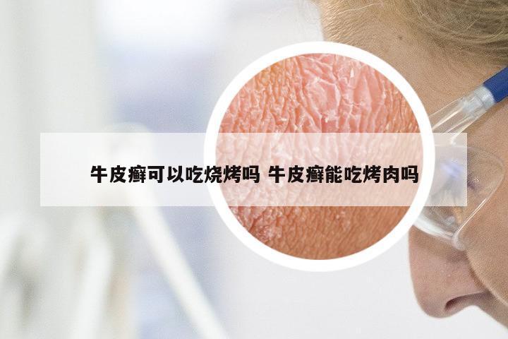 牛皮癣可以吃烧烤吗 牛皮癣能吃烤肉吗