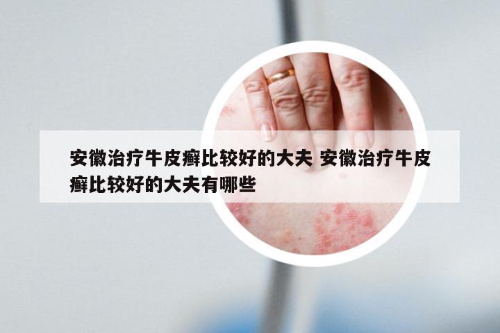 安徽治疗牛皮癣比较好的大夫 安徽治疗牛皮癣比较好的大夫有哪些