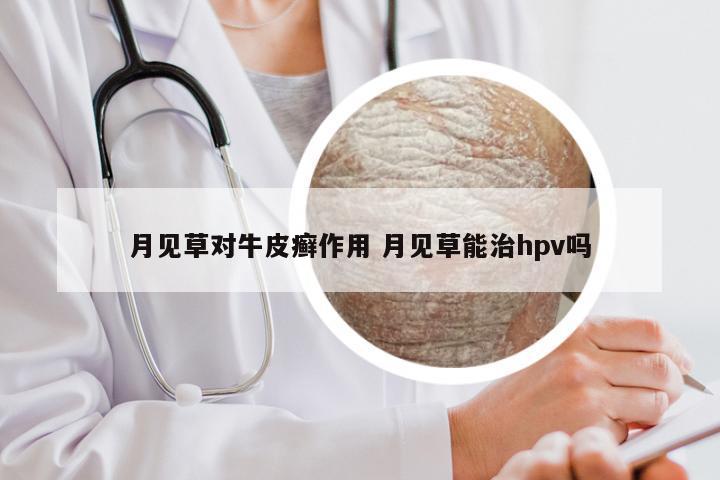 月见草对牛皮癣作用 月见草能治hpv吗