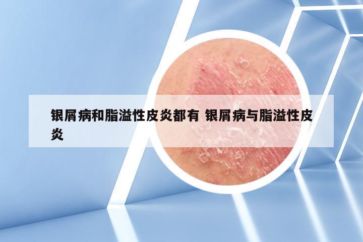 银屑病和脂溢性皮炎都有 银屑病与脂溢性皮炎