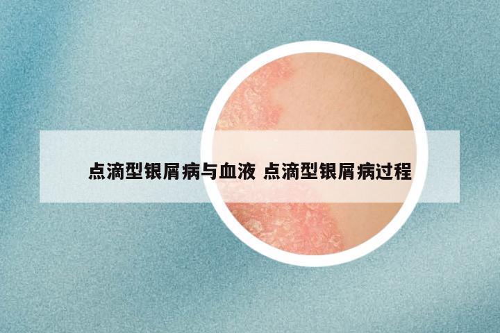 点滴型银屑病与血液 点滴型银屑病过程