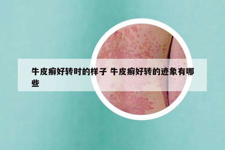 牛皮癣好转时的样子 牛皮癣好转的迹象有哪些