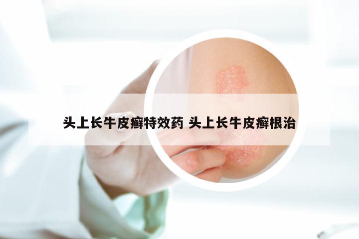 头上长牛皮癣特效药 头上长牛皮癣根治
