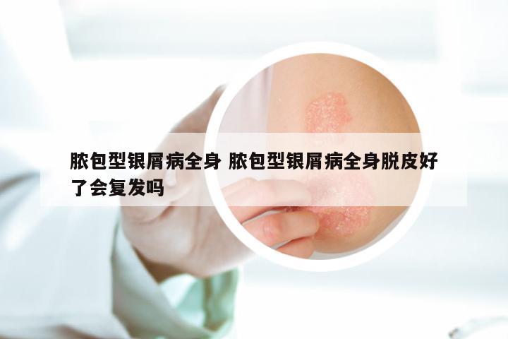脓包型银屑病全身 脓包型银屑病全身脱皮好了会复发吗