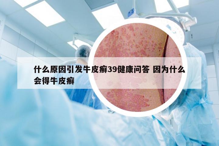 什么原因引发牛皮癣39健康问答 因为什么会得牛皮癣