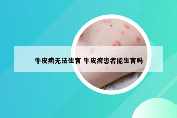 牛皮癣无法生育 牛皮癣患者能生育吗