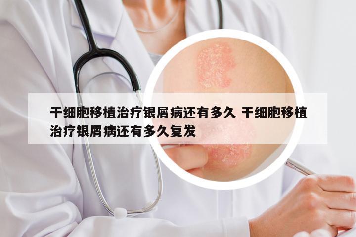 干细胞移植治疗银屑病还有多久 干细胞移植治疗银屑病还有多久复发