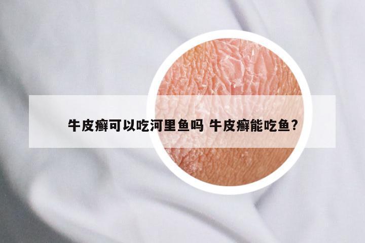 牛皮癣可以吃河里鱼吗 牛皮癣能吃鱼?