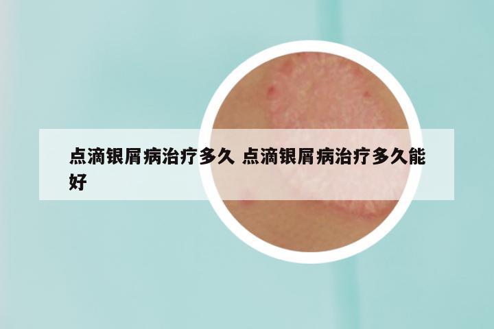 点滴银屑病治疗多久 点滴银屑病治疗多久能好