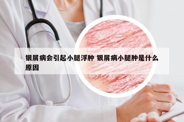 银屑病会引起小腿浮肿 银屑病小腿肿是什么原因