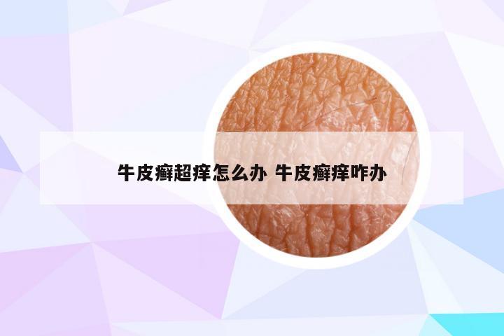 牛皮癣超痒怎么办 牛皮癣痒咋办