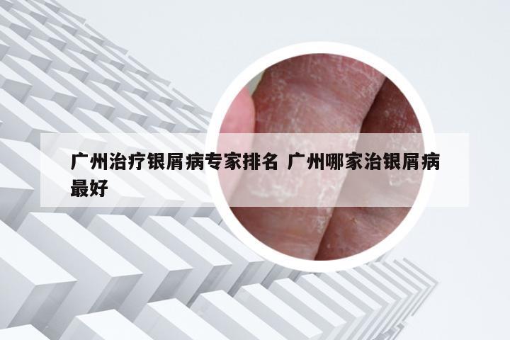 广州治疗银屑病专家排名 广州哪家治银屑病最好