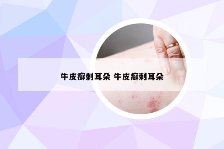 牛皮癣刺耳朵 牛皮癣剌耳朵