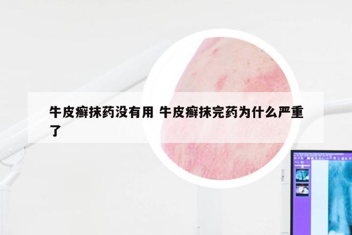 牛皮癣抹药没有用 牛皮癣抹完药为什么严重了