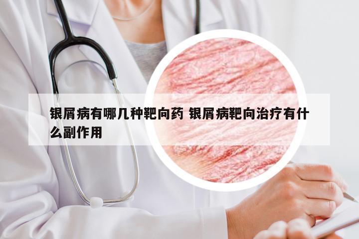银屑病有哪几种靶向药 银屑病靶向治疗有什么副作用