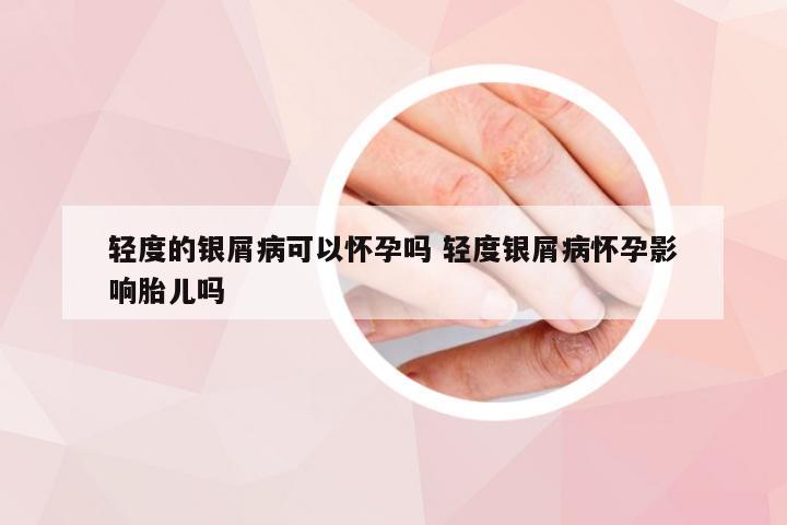 轻度的银屑病可以怀孕吗 轻度银屑病怀孕影响胎儿吗