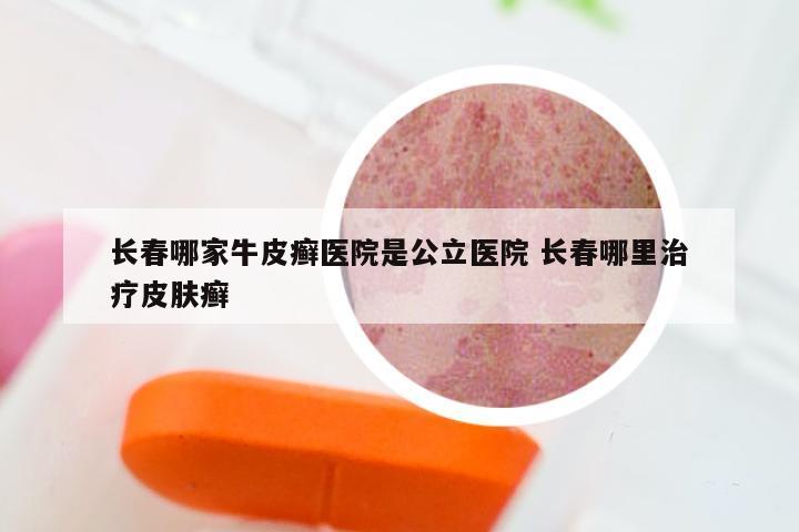 长春哪家牛皮癣医院是公立医院 长春哪里治疗皮肤癣