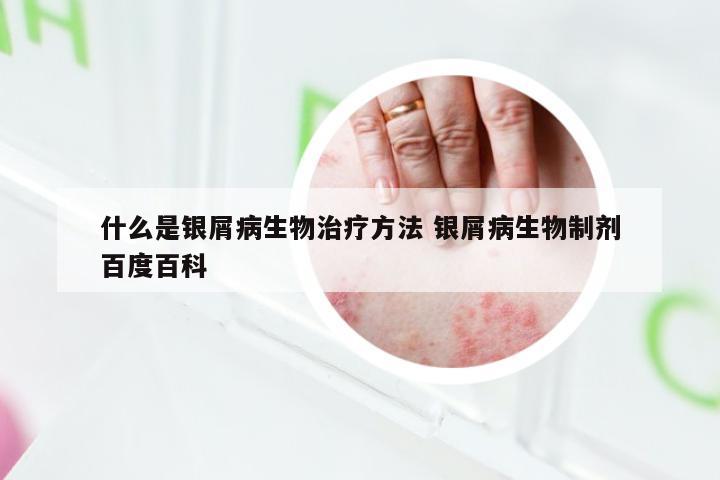 什么是银屑病生物治疗方法 银屑病生物制剂百度百科