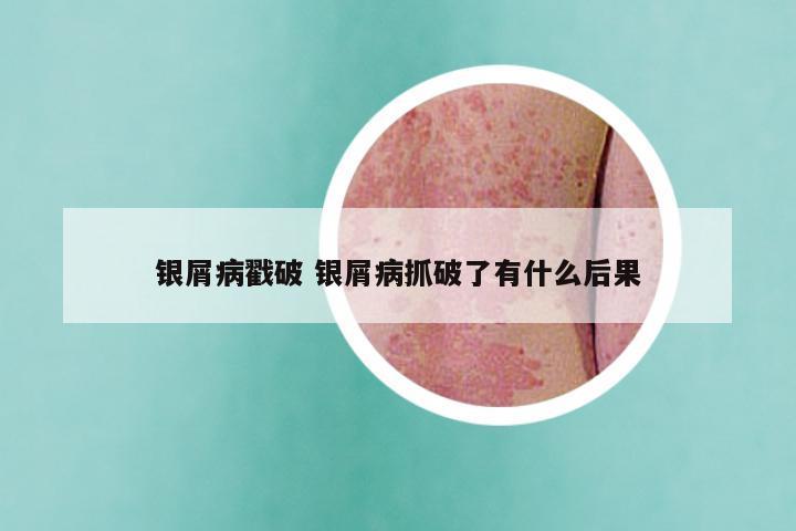 银屑病戳破 银屑病抓破了有什么后果