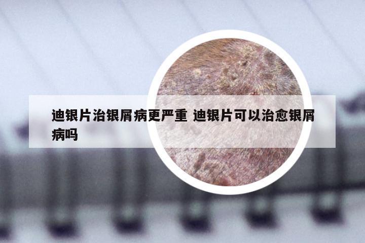 迪银片治银屑病更严重 迪银片可以治愈银屑病吗