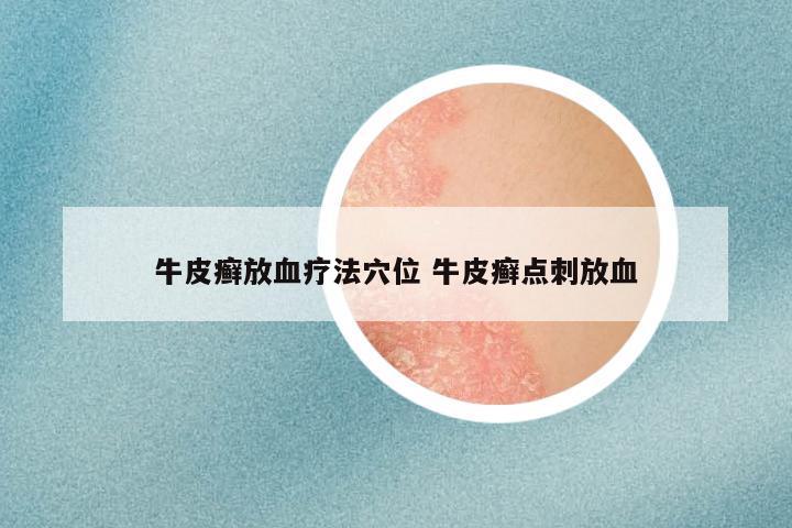 牛皮癣放血疗法穴位 牛皮癣点刺放血