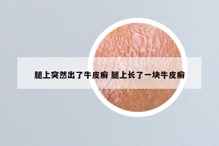 腿上突然出了牛皮癣 腿上长了一块牛皮癣