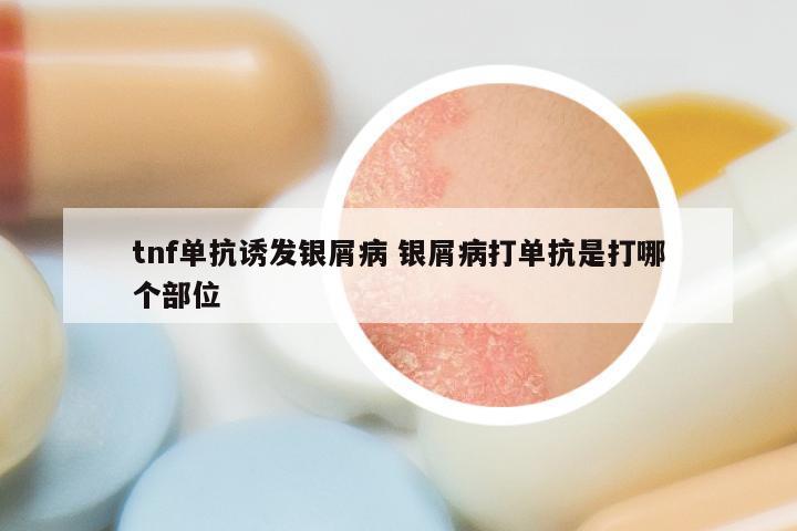 tnf单抗诱发银屑病 银屑病打单抗是打哪个部位