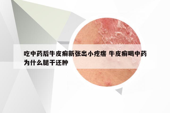 吃中药后牛皮癣新张出小疙瘩 牛皮癣喝中药为什么腿干还肿