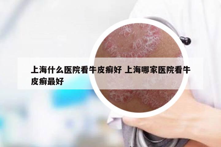 上海什么医院看牛皮癣好 上海哪家医院看牛皮癣最好