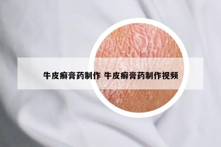 牛皮癣膏药制作 牛皮癣膏药制作视频
