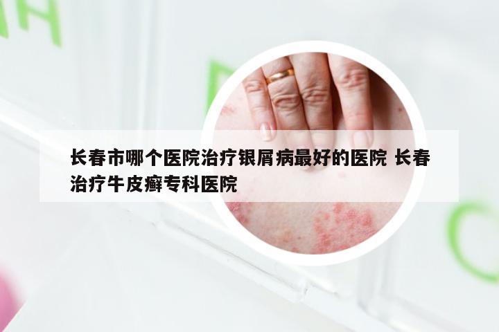 长春市哪个医院治疗银屑病最好的医院 长春治疗牛皮癣专科医院