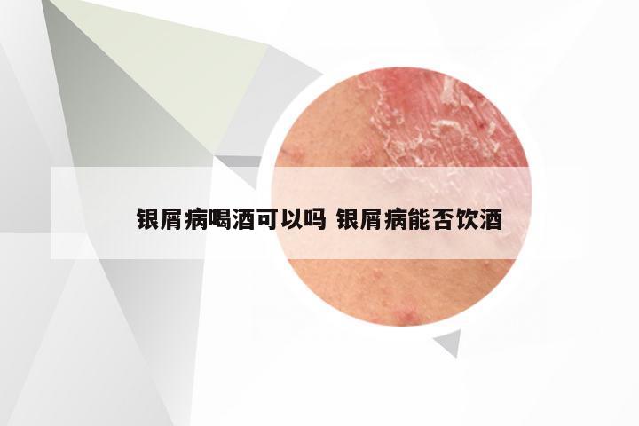 银屑病喝酒可以吗 银屑病能否饮酒
