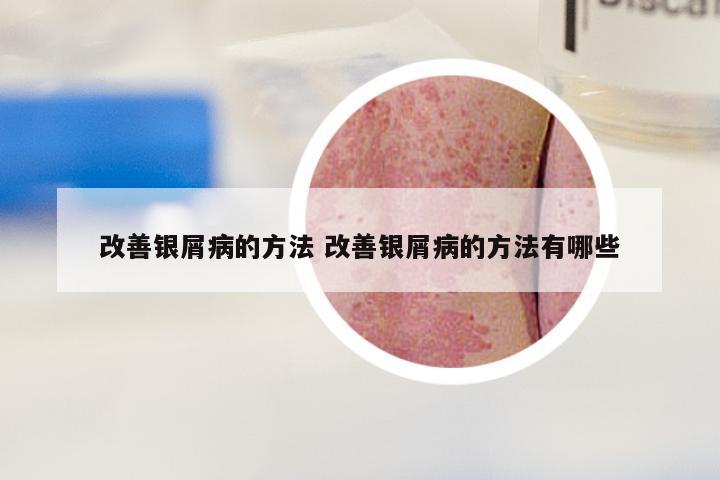 改善银屑病的方法 改善银屑病的方法有哪些