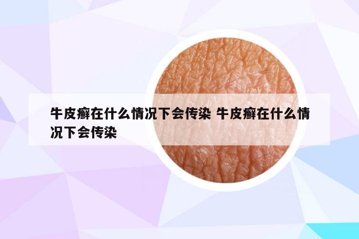 牛皮癣在什么情况下会传染 牛皮癣在什么情况下会传染