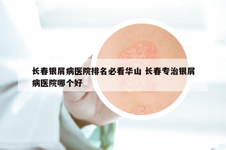 长春银屑病医院排名必看华山 长春专治银屑病医院哪个好