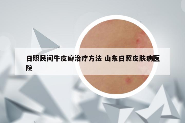 日照民间牛皮癣治疗方法 山东日照皮肤病医院