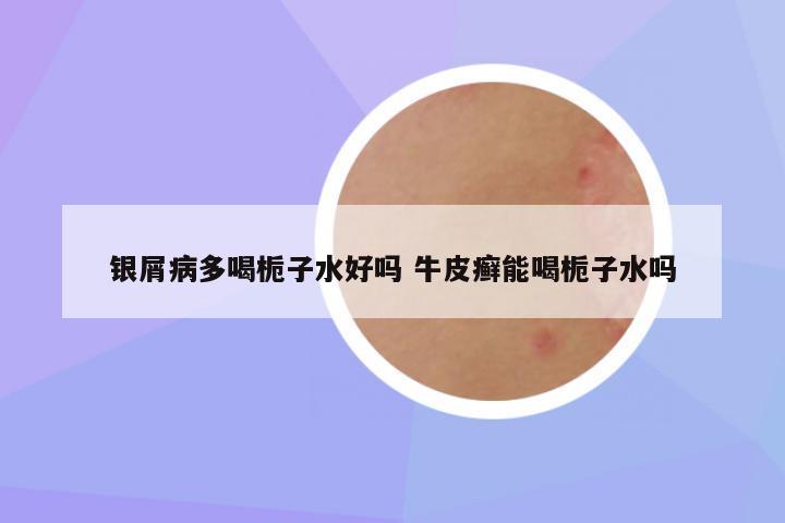 银屑病多喝栀子水好吗 牛皮癣能喝栀子水吗