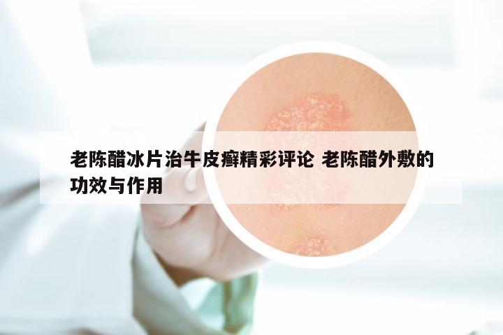 老陈醋冰片治牛皮癣精彩评论 老陈醋外敷的功效与作用