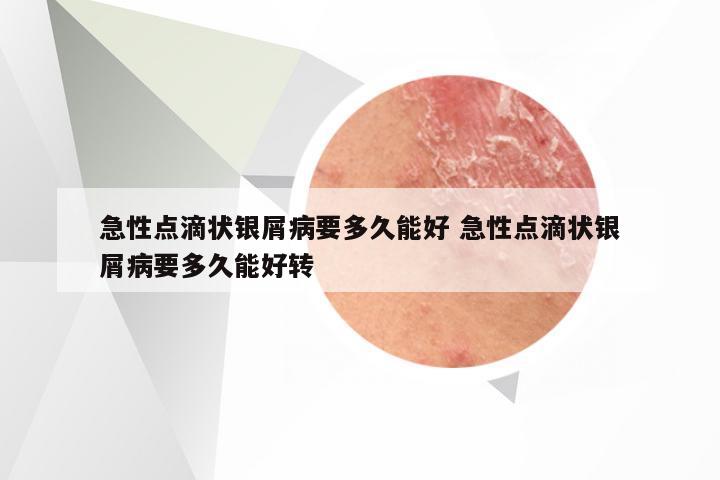 急性点滴状银屑病要多久能好 急性点滴状银屑病要多久能好转