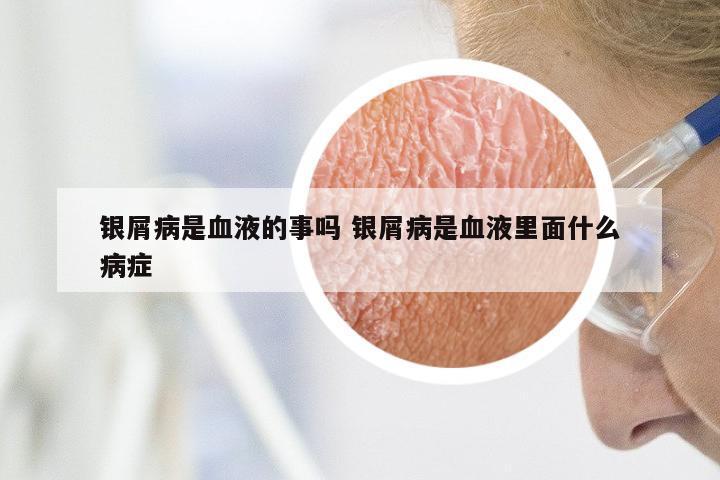 银屑病是血液的事吗 银屑病是血液里面什么病症