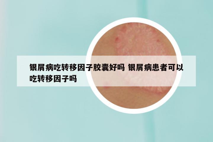 银屑病吃转移因子胶囊好吗 银屑病患者可以吃转移因子吗