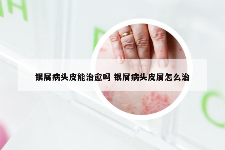 银屑病头皮能治愈吗 银屑病头皮屑怎么治