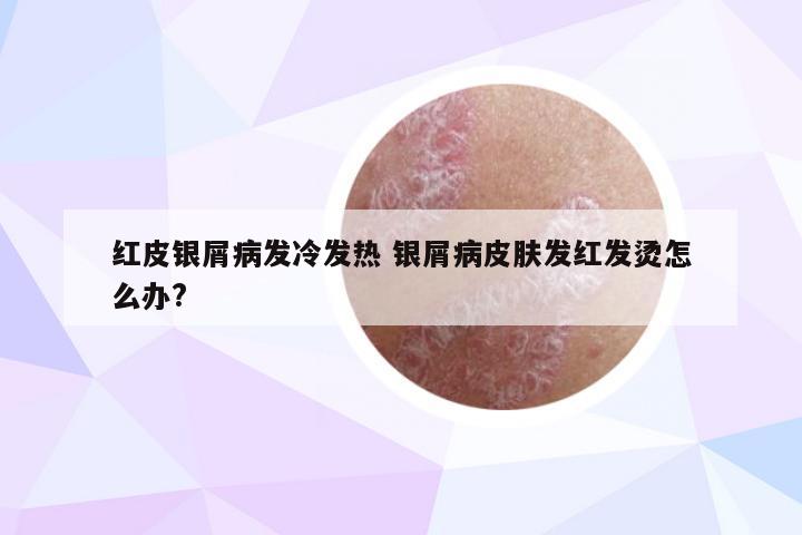 红皮银屑病发冷发热 银屑病皮肤发红发烫怎么办?